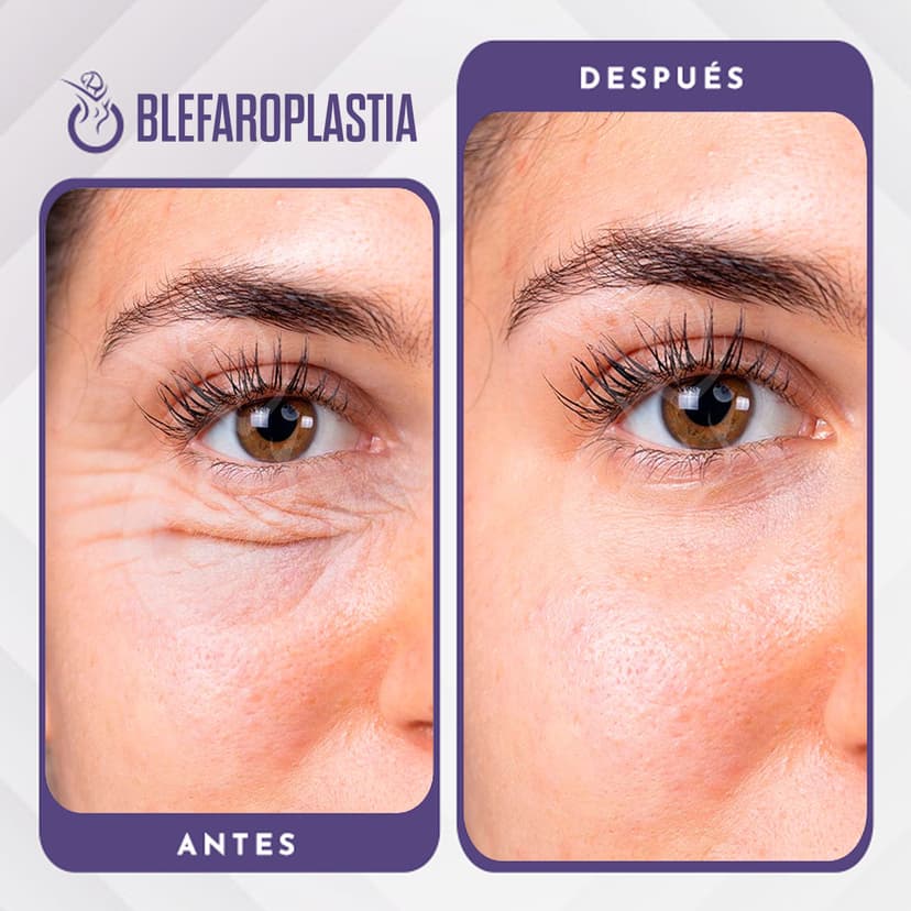 Blefaroplastia