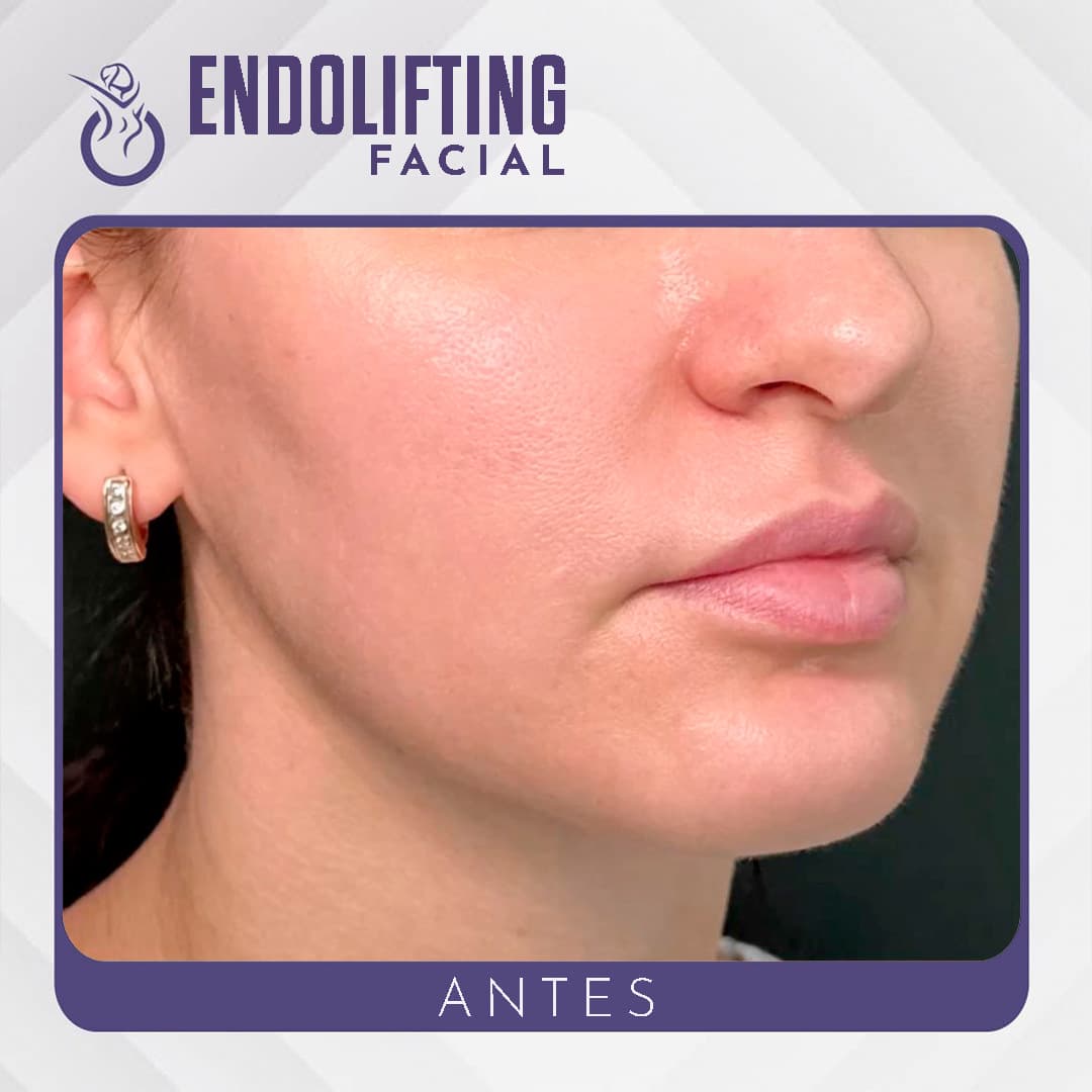 Antes