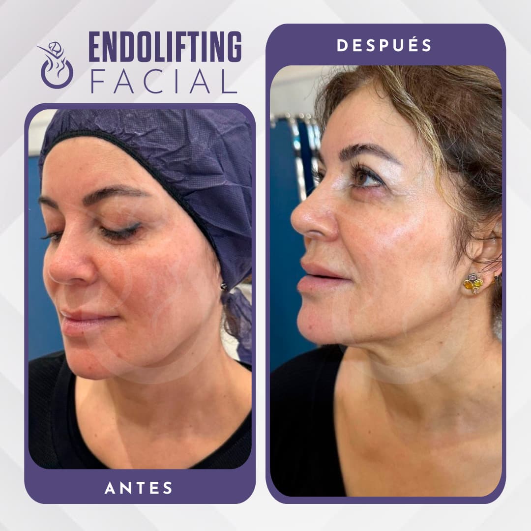 Lifting facial - Antes