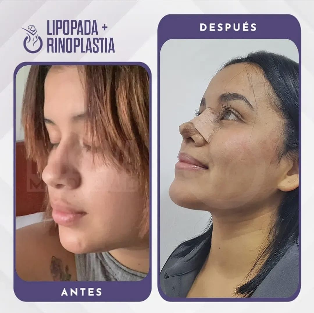 Lipopapada + Bichectomía - Antes