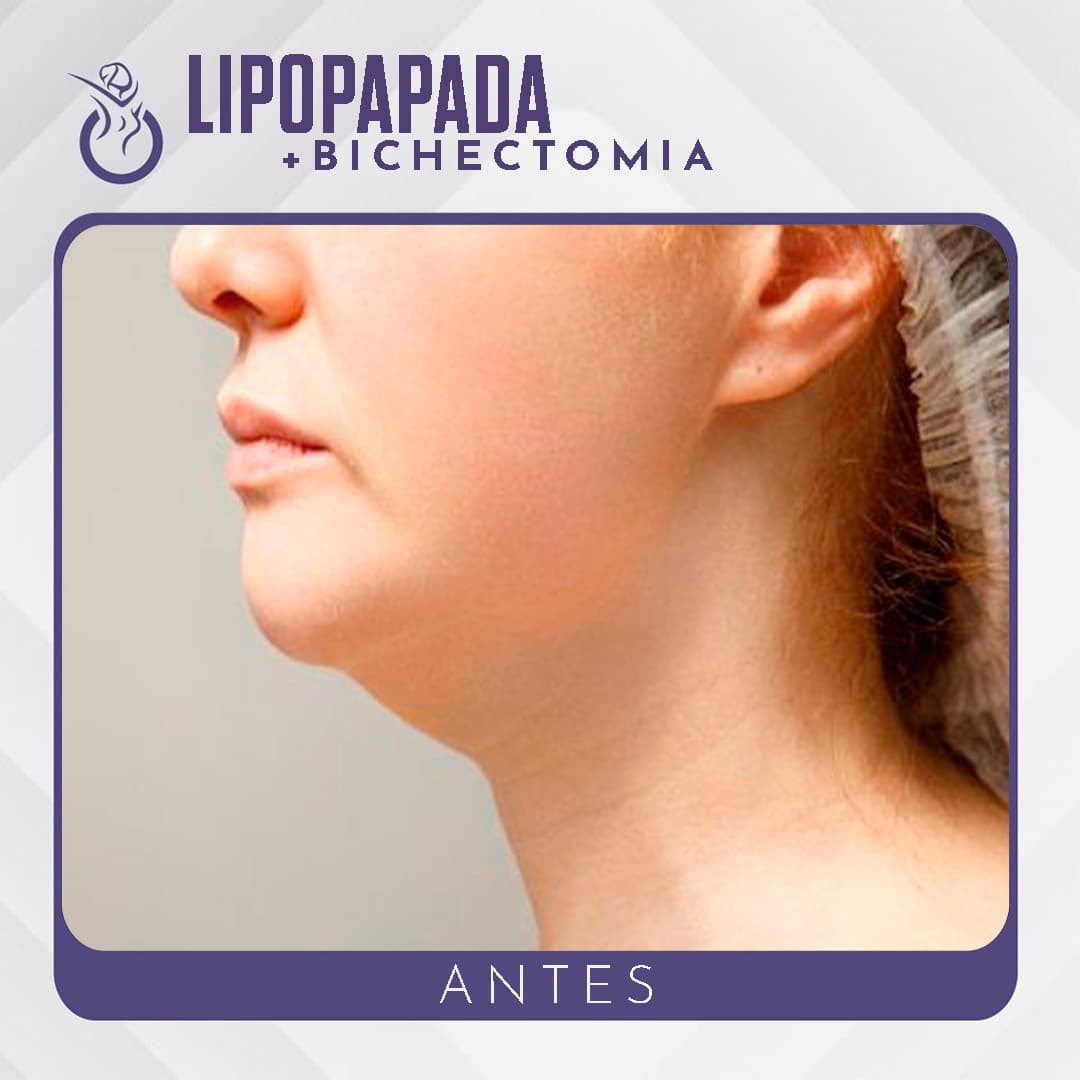 Antes